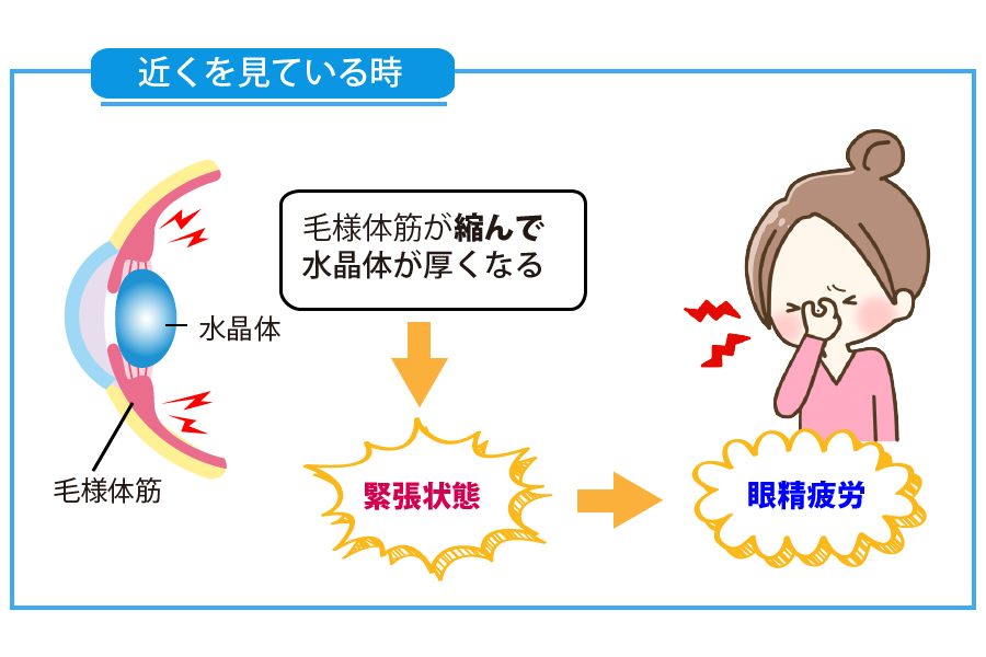 毛様体筋の緊張で起こる眼精疲労